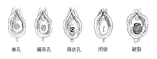 不同形状的处女膜