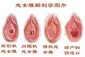 生理解剖：不同形状的处女膜